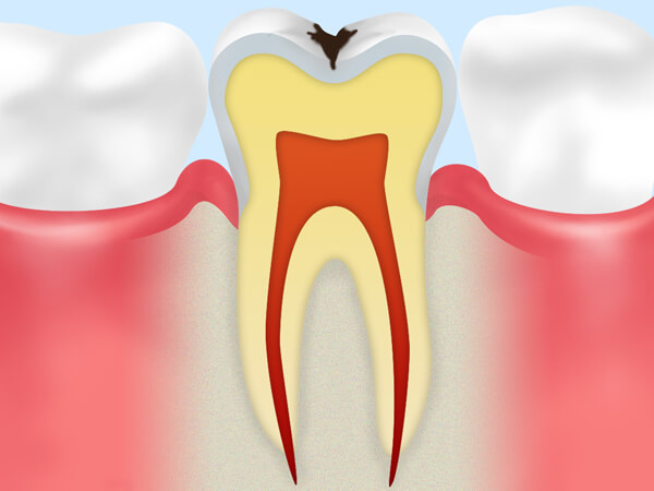 2.エナメル質の虫歯（C1）