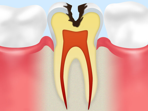 3.象牙質の虫歯（C2）