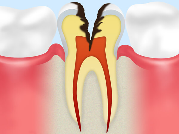 4.歯の神経にまで達した虫歯（C3）