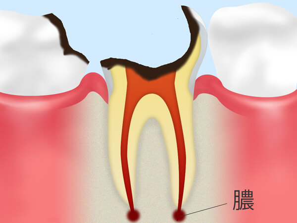 5.歯根だけが残った状態（C4）
